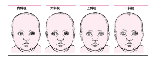 什么是斜視？斜視能嗎？