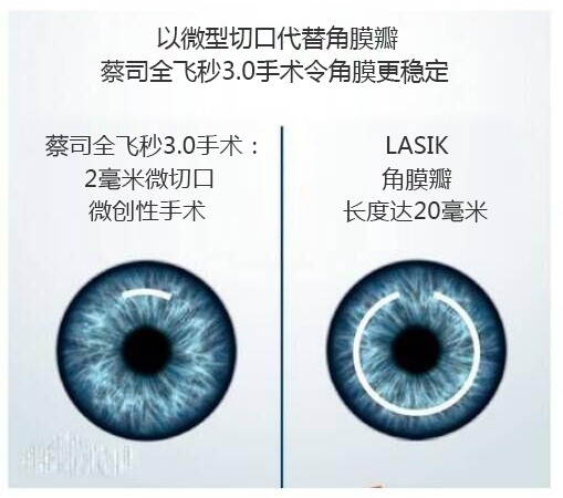 做完近視手術(shù)要休息多長時間？需要住院嗎？