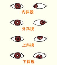 看看兒童斜視眼病怎么預(yù)防？