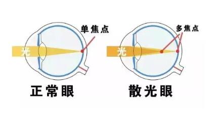 近視和散光，手術(shù)能同時(shí)矯正嗎？